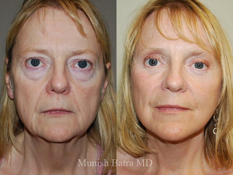 Before and After Image