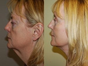 Before and After Image