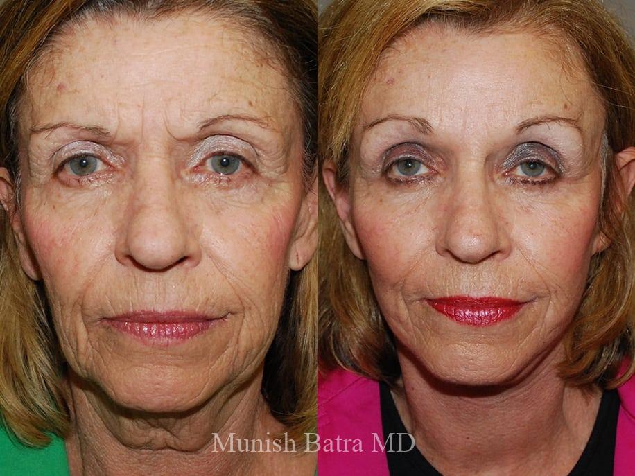 Before and After Image