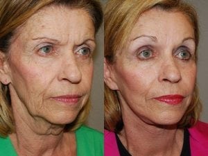 Before and After Image
