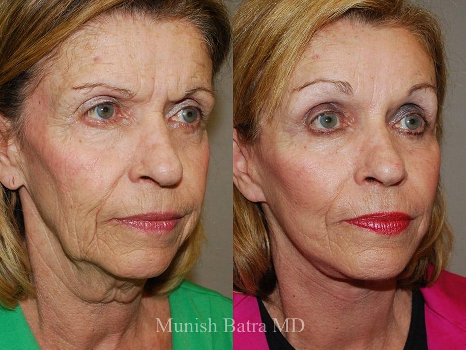 Before and After Image