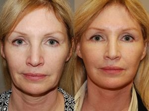 Before and After Image