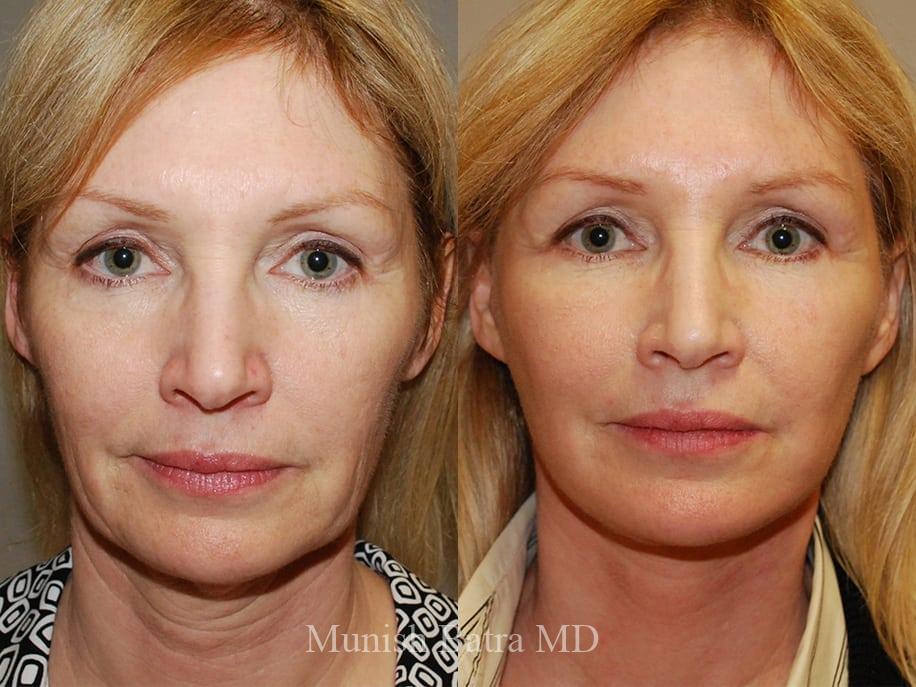 Before and After Image