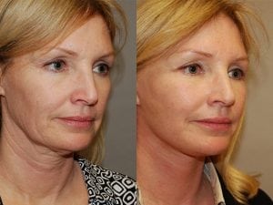 Before and After Image