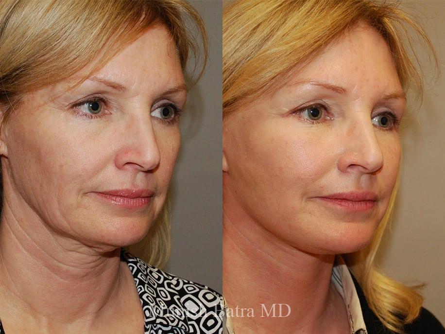 Before and After Image