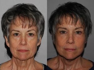 Before and After Image