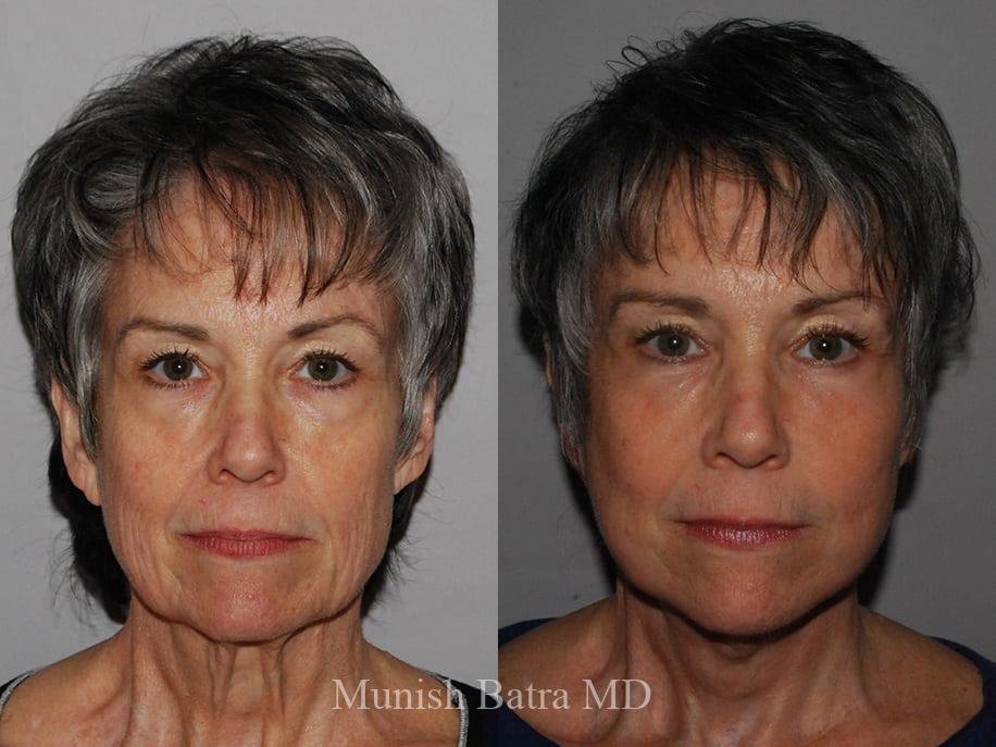 Before and After Image
