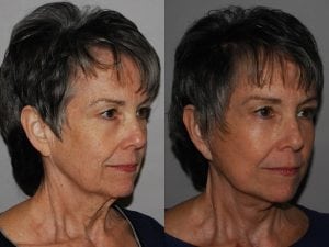 Before and After Image