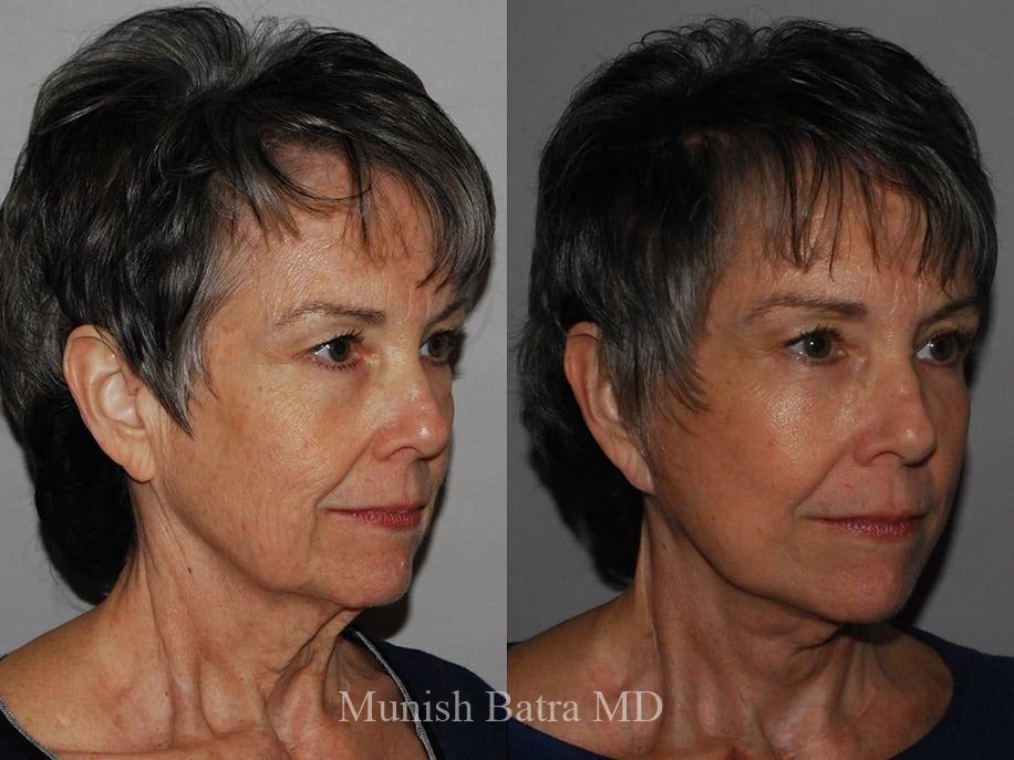 Before and After Image