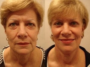 Before and After Image