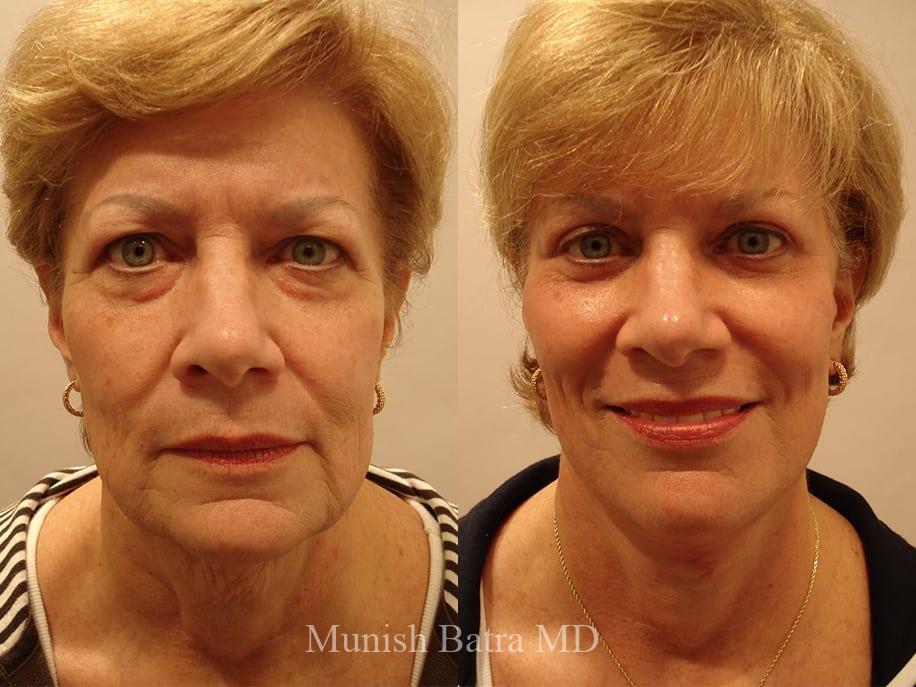 Before and After Image