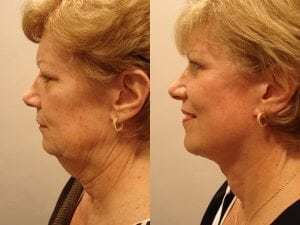 Before and After Image