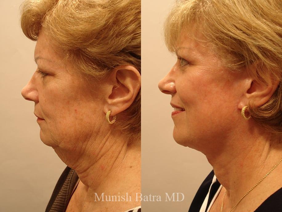 Before and After Image
