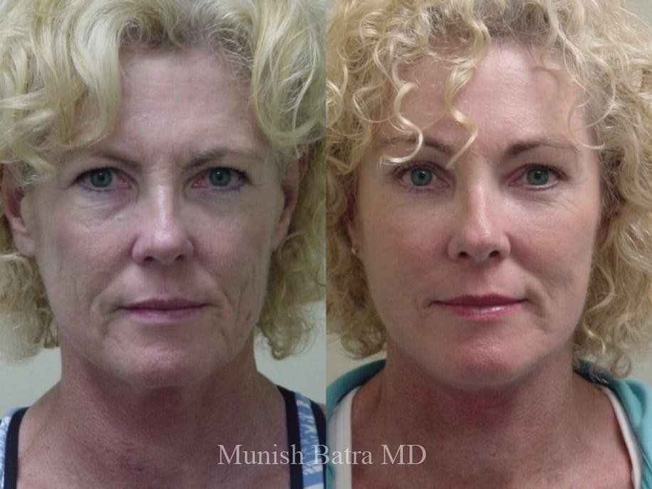 Before and After Image