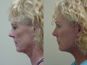 Before and After Image