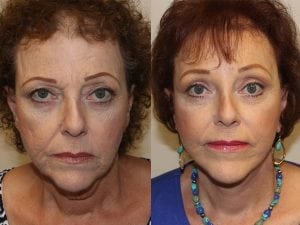 Before and After Image