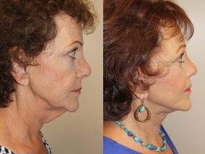 Before and After Image