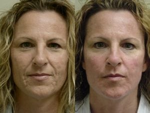 Before and After Image