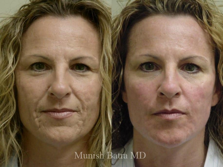 Before and After Image