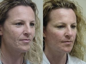 Before and After Image