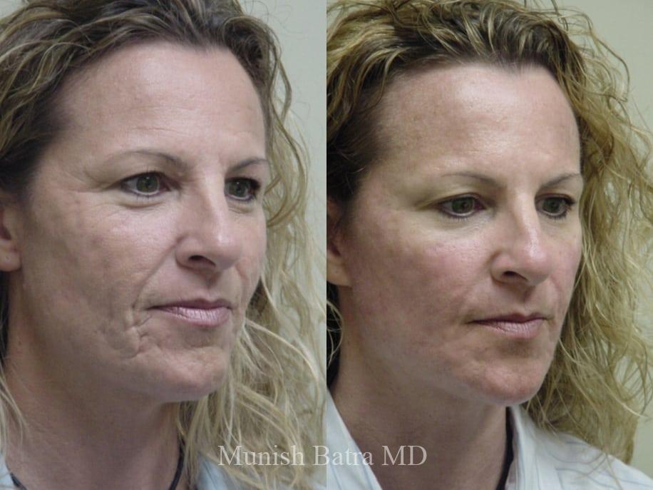 Before and After Image