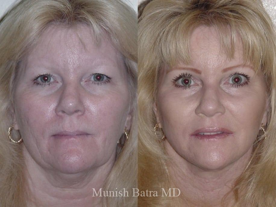 Before and After Image