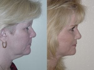 Before and After Image