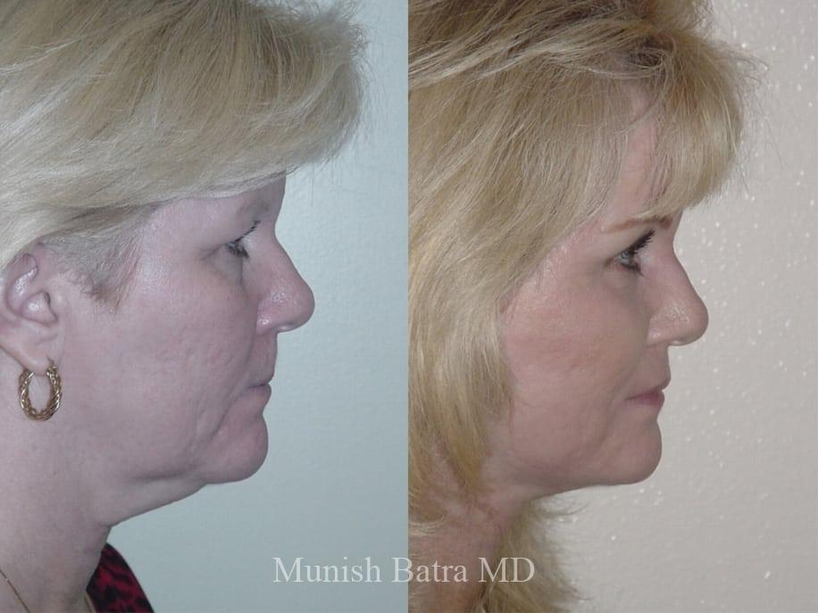 Before and After Image