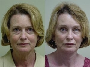 Before and After Image