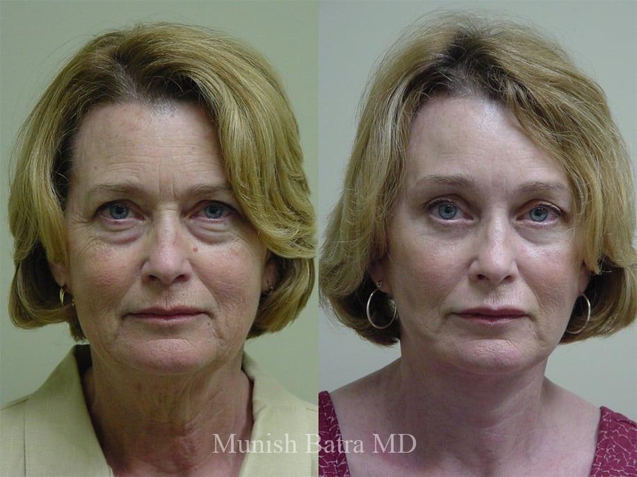 Before and After Image