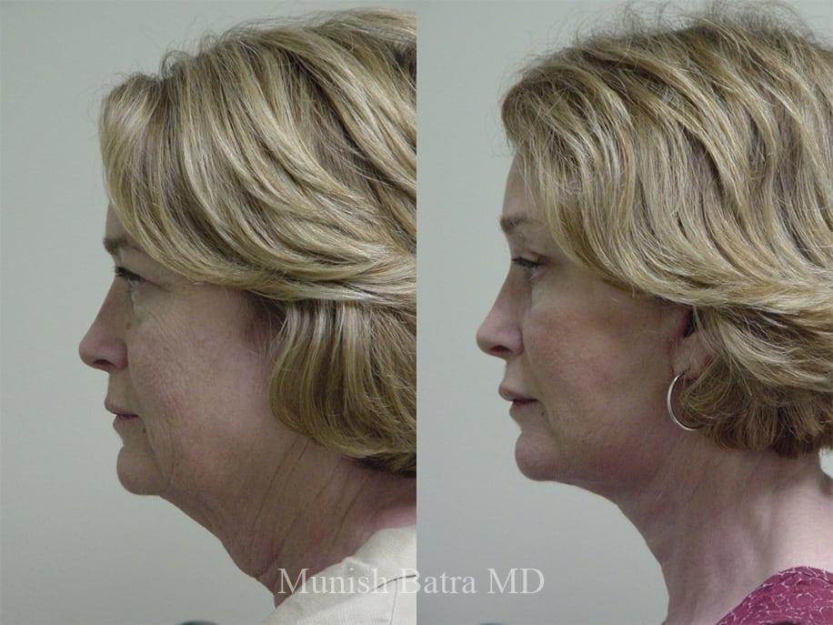 Before and After Image