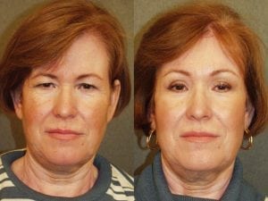 Before and After Image