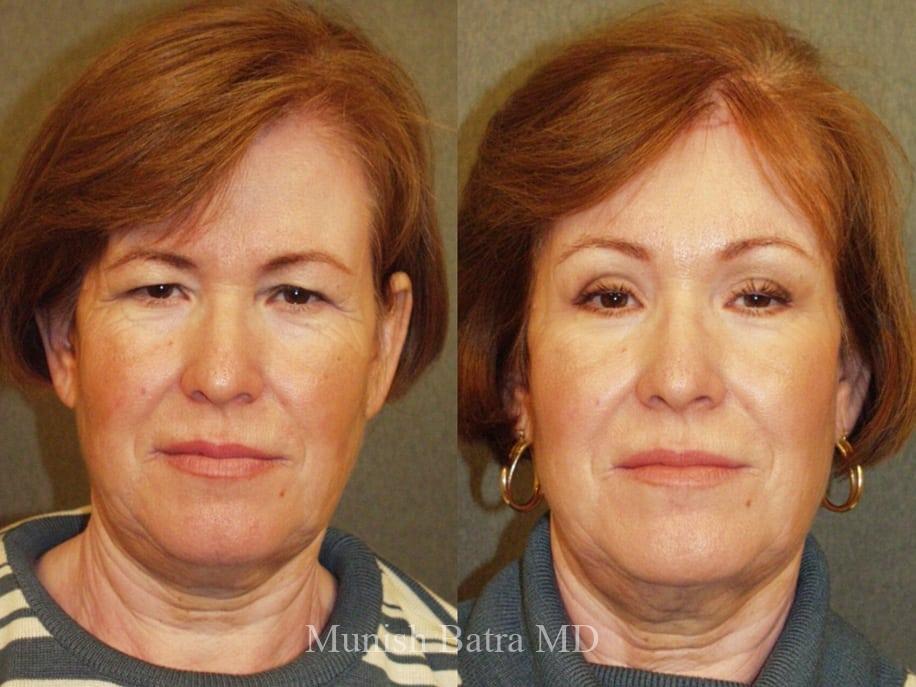 Before and After Image