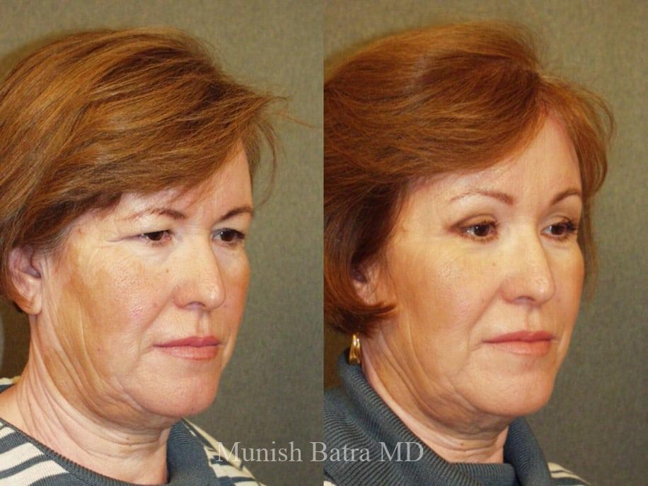 Before and After Image
