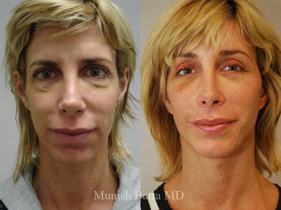 Before and After Image