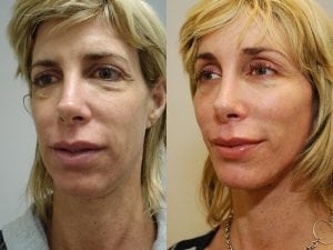 Before and After Image