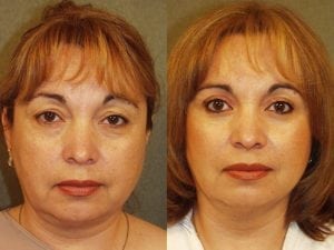 Before and After Image