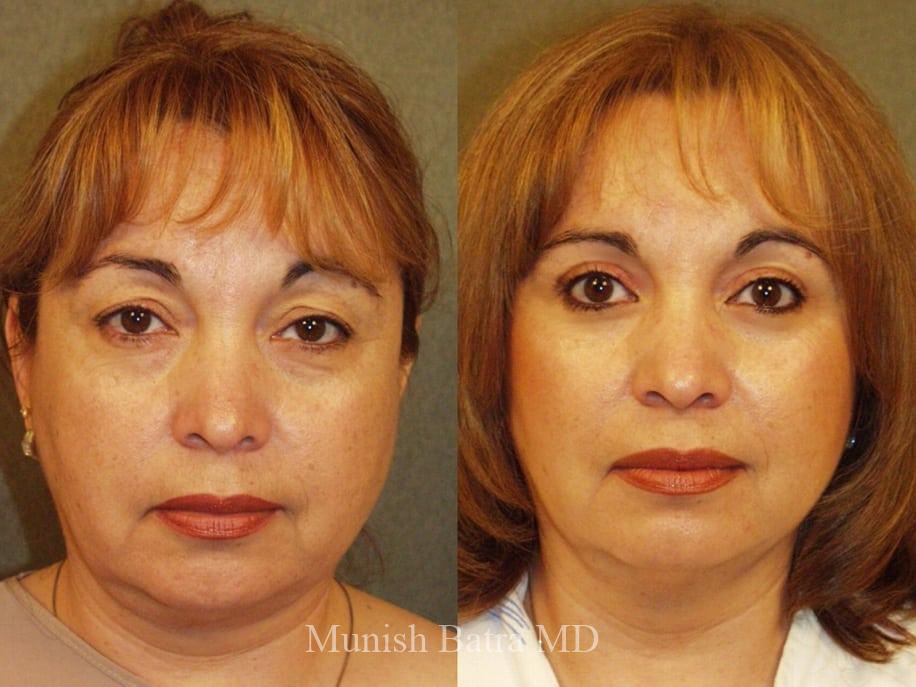 Before and After Image