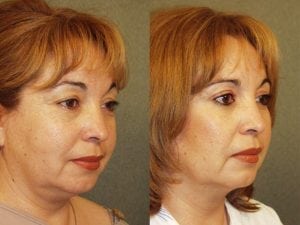 Before and After Image