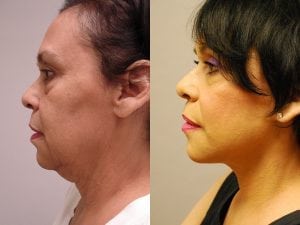 Before and After Image