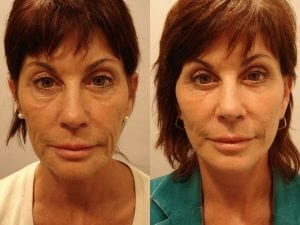 Before and After Image