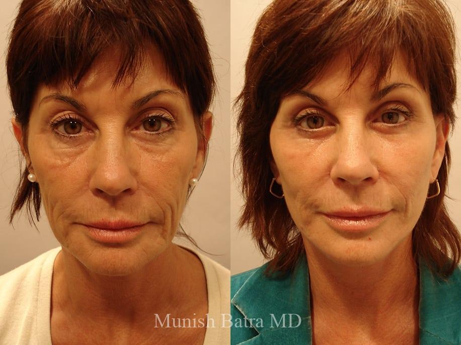 Before and After Image