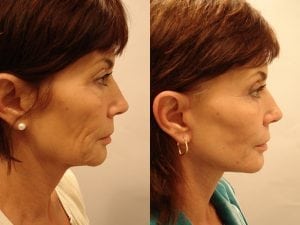 Before and After Image