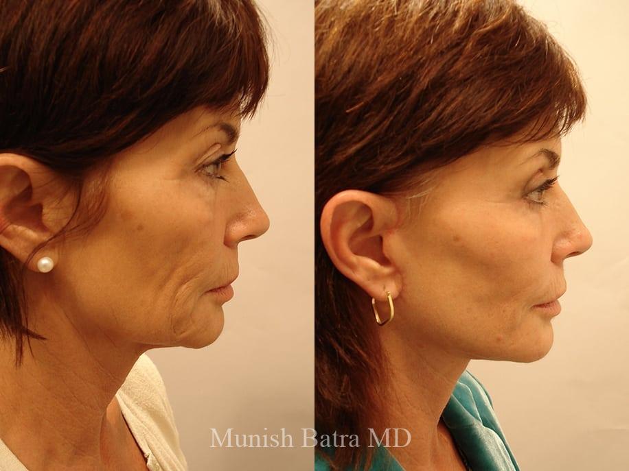 Before and After Image