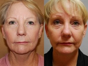Before and After Image