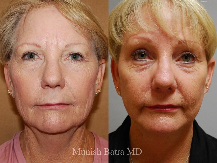 Before and After Image