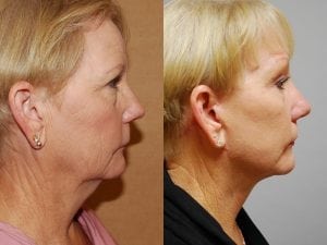 Before and After Image
