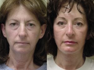 Before and After Image