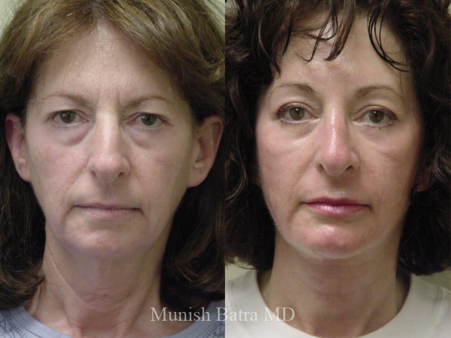 Before and After Image
