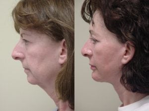 Before and After Image